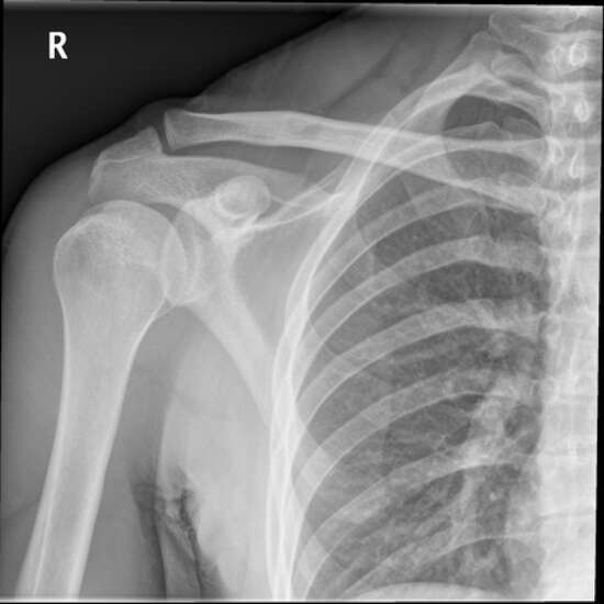 X-Ray Both Shoulders AP View